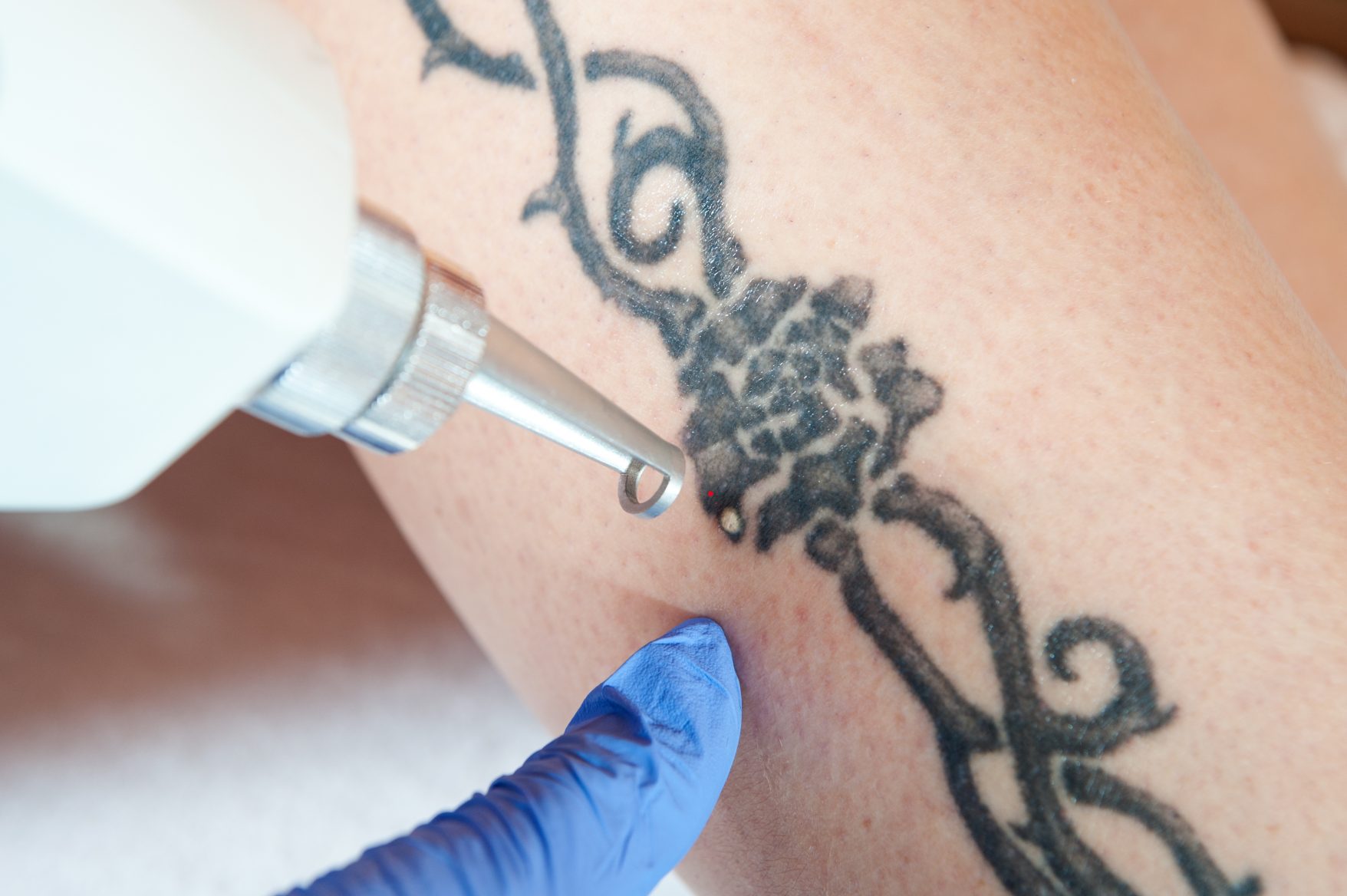 Tattoo Removal Services Kochi | Tattoo removal with Laser Treatment